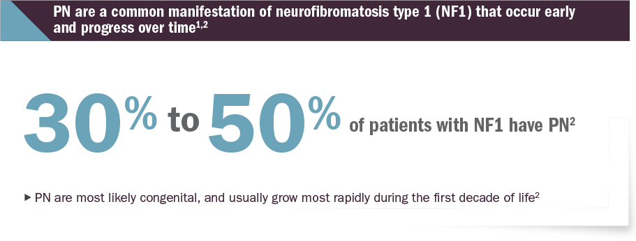 Plexiform Neurofibroma Prevalence – 30% to 50% of Patients with NF1 have PN